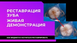 ПРЯМАЯ РЕСТАВРАЦИЯ ЗУБА ЖИВАЯ ДЕМОНСТРАЦИЯ