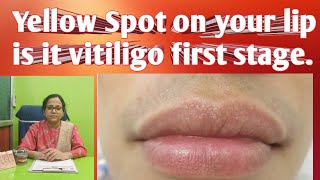 Yellow Spot on lip like pimple what is it.All about yellow spot on lip ,is it 1st stage of vitiligo