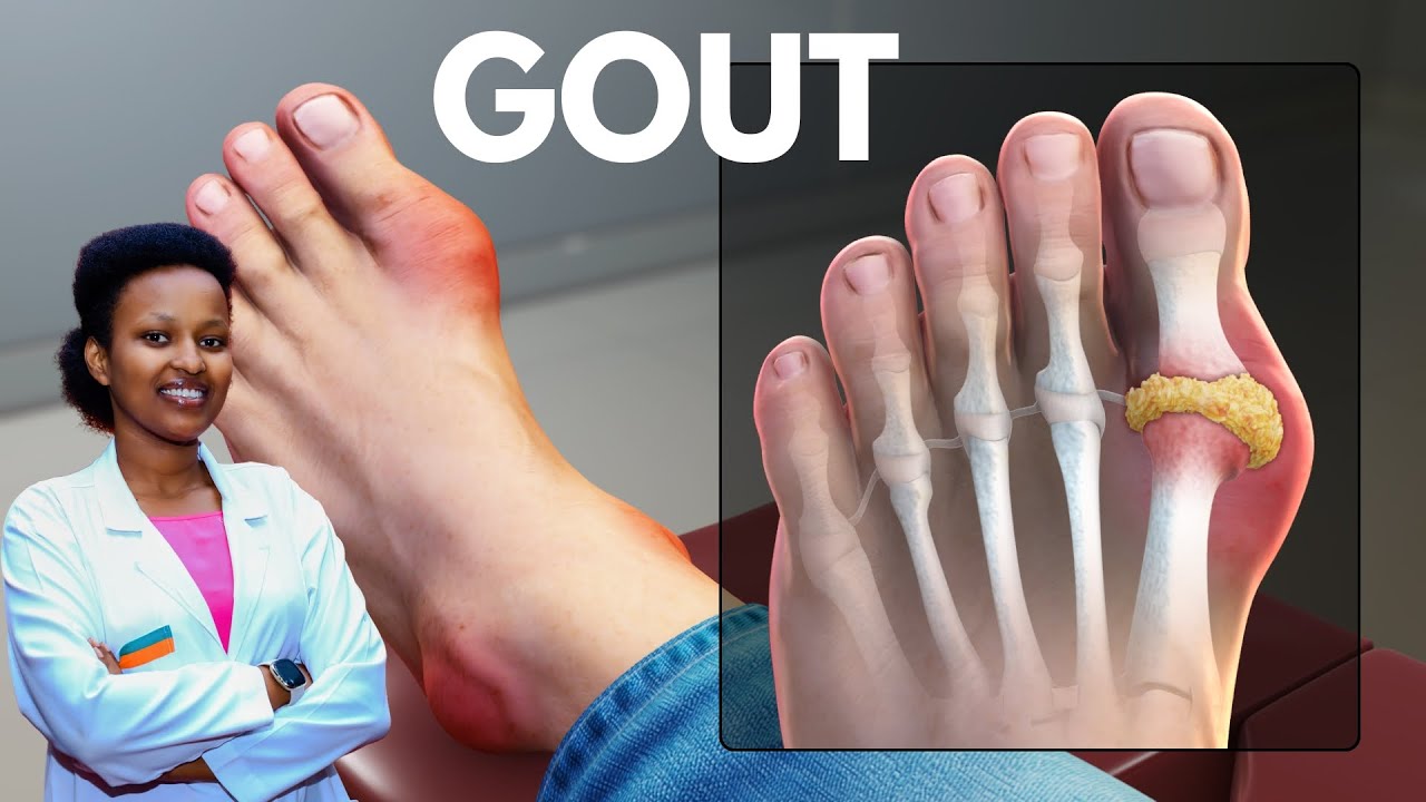 GOUTE: INYAMA ZITUKURA, Inzoga nyinshi! Bimwe mu biyitera! Menya uko warya niba uyirwaye.