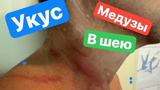 МЕНЯ УЖАЛИЛА МЕДУЗА!