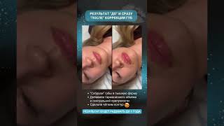 💋 Мечтаете о губах, но боитесь «супер-объёма»?