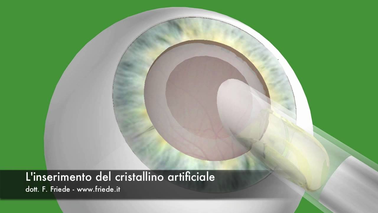 Sostituzione Cristallino A 50 Anni Inserimento del cristallino artificiale - YouTube
