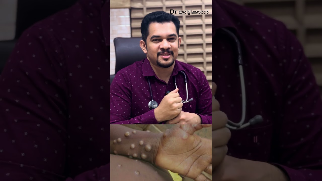 കണ്ണൂരിൽ മങ്കിപോക്സ് സ്ഥിരീകരിച്ചു. എങ്ങനെ പകരുന്നു? എന്താണ് ലക്ഷണങ്ങൾ? 