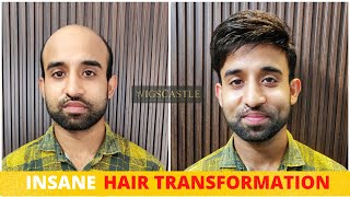 Non Surgical Hair Fixing, Hair Wig,  Patching Center in Bangalore. Call 9577295779