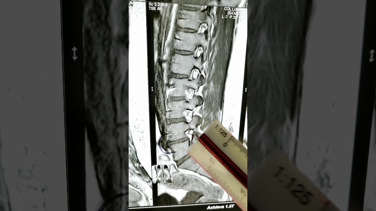 hernia-discal-lumbar-con-extrusi-n-vista-en-resonancia-magn-tica