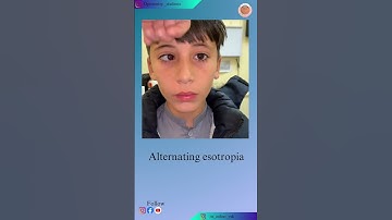 Alternating esotropia #squints #eye #cover #humananatomy #rap #eye #optometry #humaneyes #humaneye