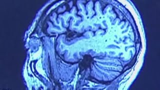 Healthy SA: Recognizing the signs of a concussion