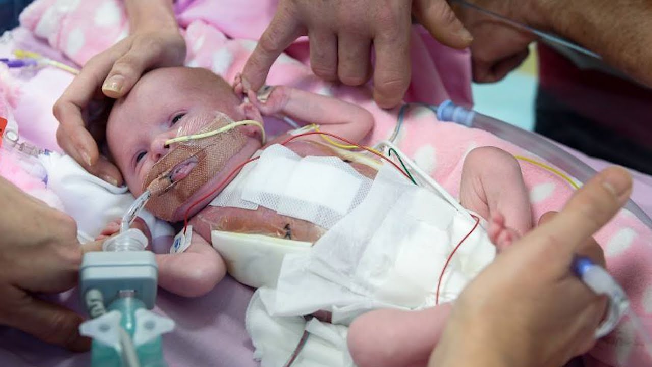 Newborn Survives Risky Surgery After Being Born With Heart Outside Body