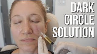 Dark Circle Treatment With PRP (Platelet Rich Plasma)