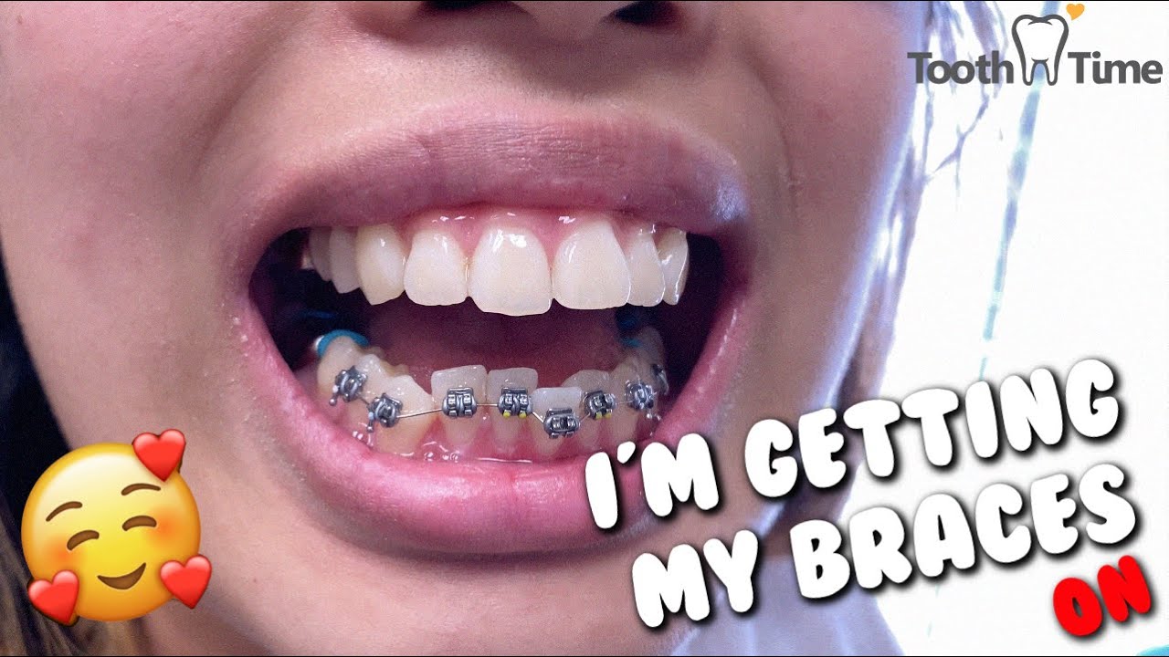 Braces Check up - Wire change 19x25 SS to 018SS - Tooth Time Family  Dentistry New Braunfels 