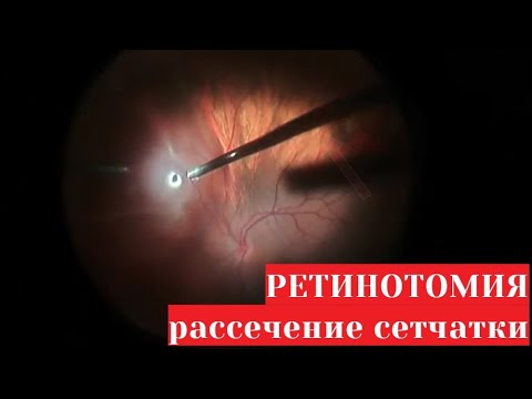 Ретинотомия - рассечение сетчатки глаза