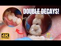 AMAZING Molar and Premolar DOUBLE DECAY Teeth Restoration on Real Patient in 4K!!