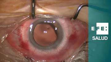 ¿Cómo mejorar la vista borrosa sin lentes?