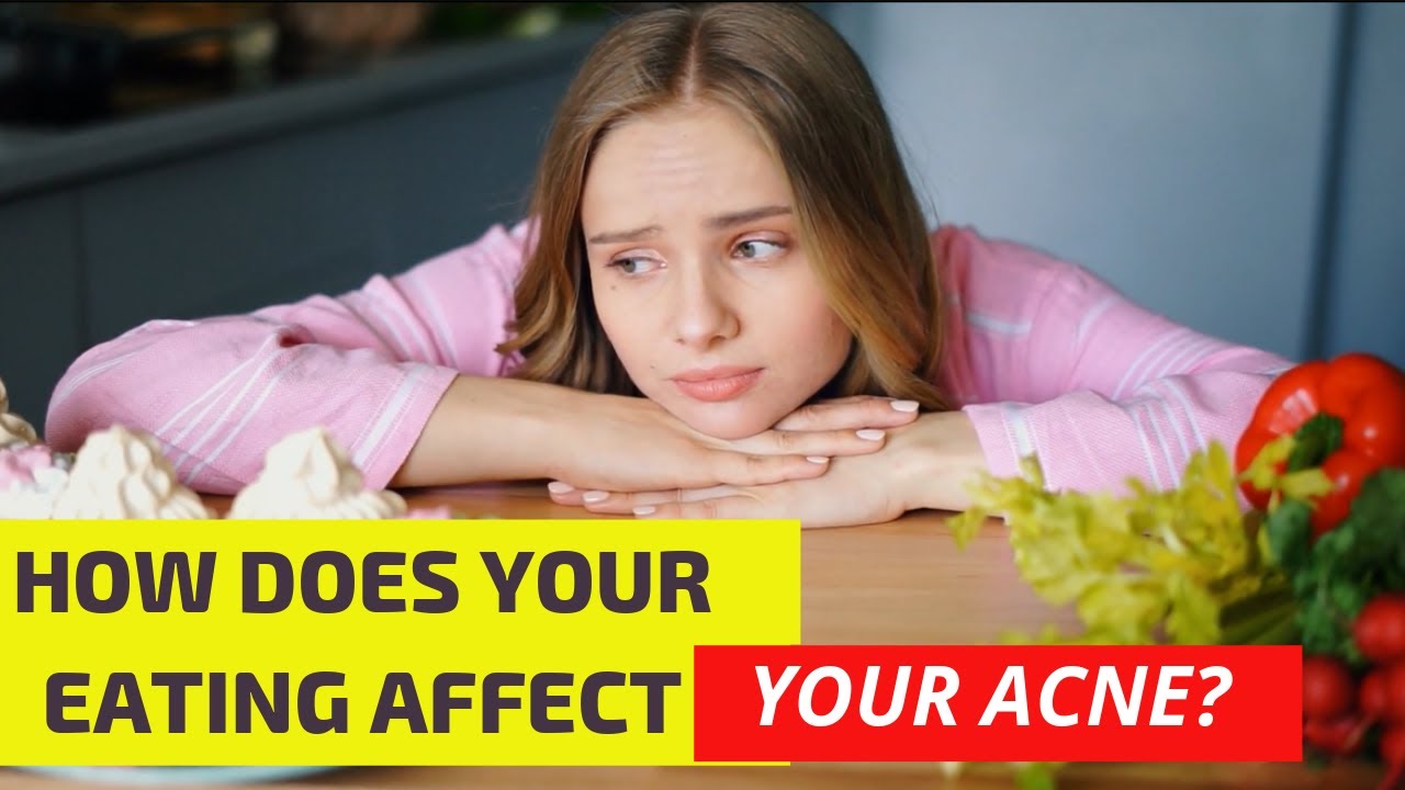 How does your eating habits affect your acne? - YouTube