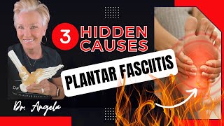 3 Hidden Causes Of Plantar Fasciitis by The Plantar Fasciitis Doc 3,465 views 10 months ago 1 minute, 33 seconds