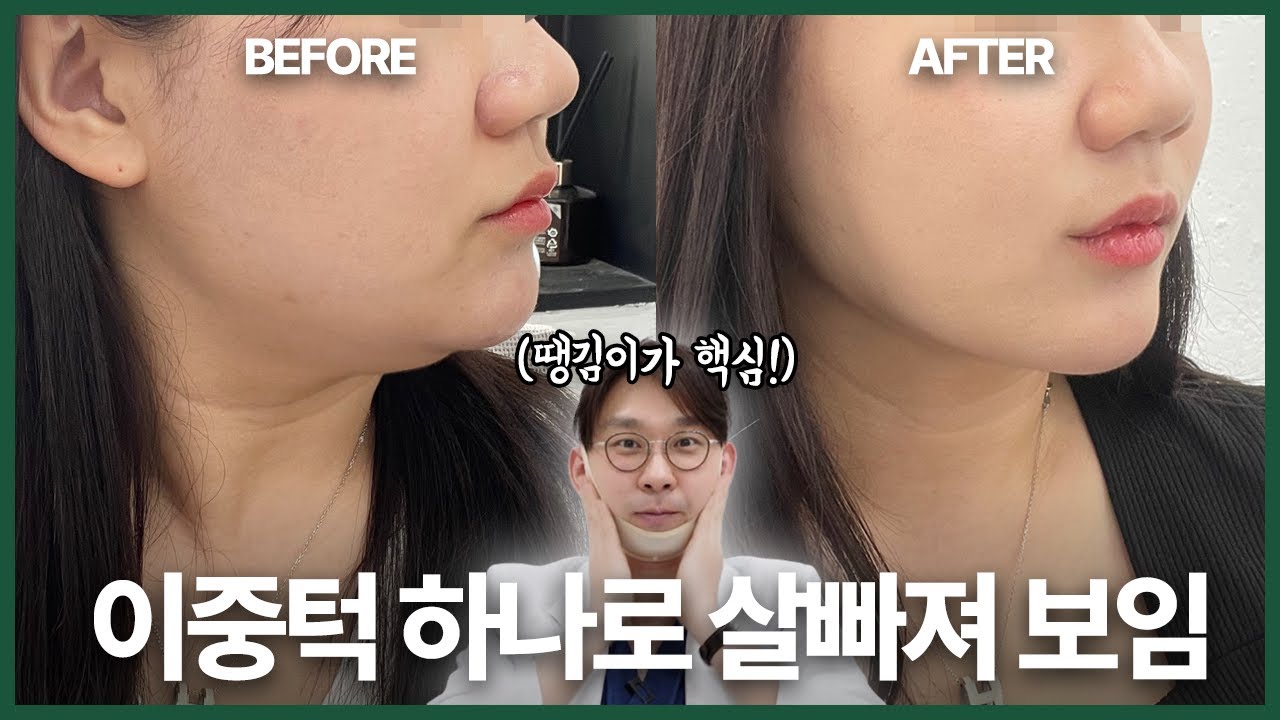 이중턱은 땡김이가 핵심입니다