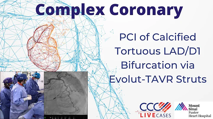 Live Complex PCI of Calcified Tortuous LAD/D1 Bifurcation via Evolut-TAVR Struts