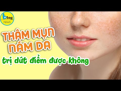 10 cách trị thâm mụn, nám da tại nhà đơn giản