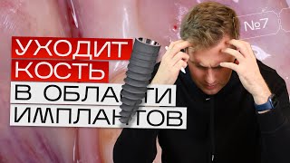 видео: Должна ли уходить кость в области имплантов? Краевая резорбция. Игорь Налиткин картинка: Должна ли уходить кость в области имплантов? Краевая резорбция. Игорь Налиткин