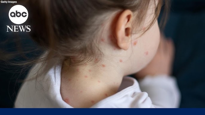 New Generation Of Doctors Learning To Spot Measles