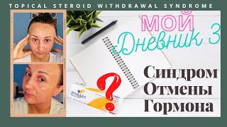 3.Дневник:Синдром Отмены Гормональной мази /Синдром Отмены Гормона /TSW syndrome