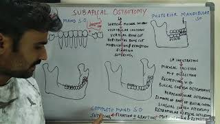 Subapical osteotomy