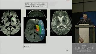 Neuro - Stroke diagnosis, mimics and treatment 3