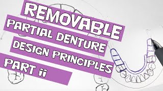 Removable Partial Denture Design Principles Part II