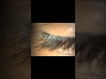 #Squamous#Blepharitis#Dandruff#Like#Material#Deposition#In#Lid#Margins#Eye#Lashes#