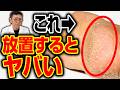【医師警告】恐ろしい内臓の病気の可能性！ただの乾燥じゃない「ガサガサのかかと」が告げるサイン