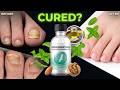 Kerassentials Review: 3 Oils to Erase Nail Fungus Fast