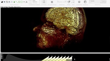 Using Miele-LXIV to look at CT Scans of Brain Rotations
