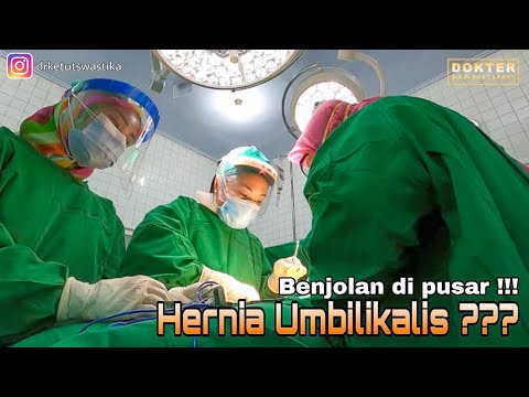 Video: Hernia Umbilikalis - Gejala, Pengobatan, Pengangkatan Pada Orang Dewasa, Pembedahan