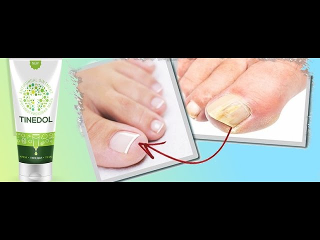 тинедол крем от грибка инструкция