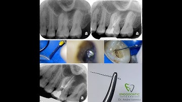 How to Break and Remove an Endodontic File - Dr. Andrei Ionescu