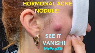 Sehr volle hormonelle Aknetasche mit Eiter!! Ich lasse sie abtropfen. Sofortige Linderung und inn...