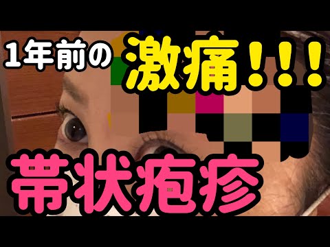 激痛！「帯状疱疹」1年前に私も顔面の帯状疱疹になりました！