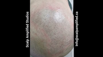 What happens during the 1st session of Scalp Micropigmentation