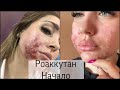 КИСТОЗНОЕ АКНЕ | РОАККУТАН | НАЧАЛО ЛЕЧЕНИЯ