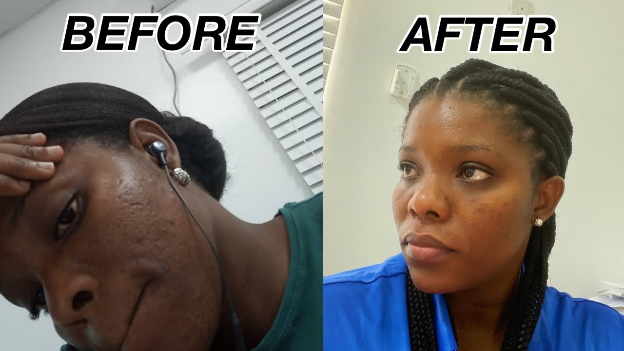 My Skincare Routine for ACNE and HYPERPIGMENTATION - How I cleared my ...