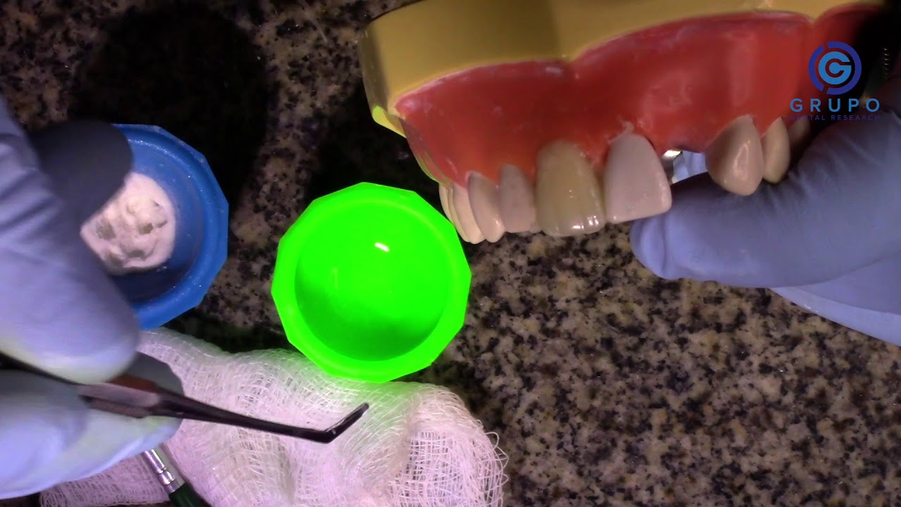 Confecção de Coroa Provisórias Anterior - Técnica da  Faceta de estoque