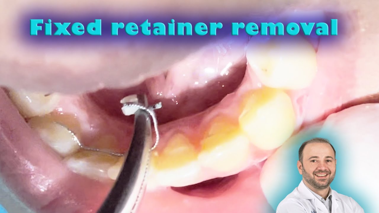 My Top Retainer Keeps Falling Out How To Fix A Broken Permanent Retainer Wire At Home at Numbers Mcleod blog