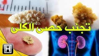 أفضل 8 طرق طبيعية لتجنب حصى الكلى