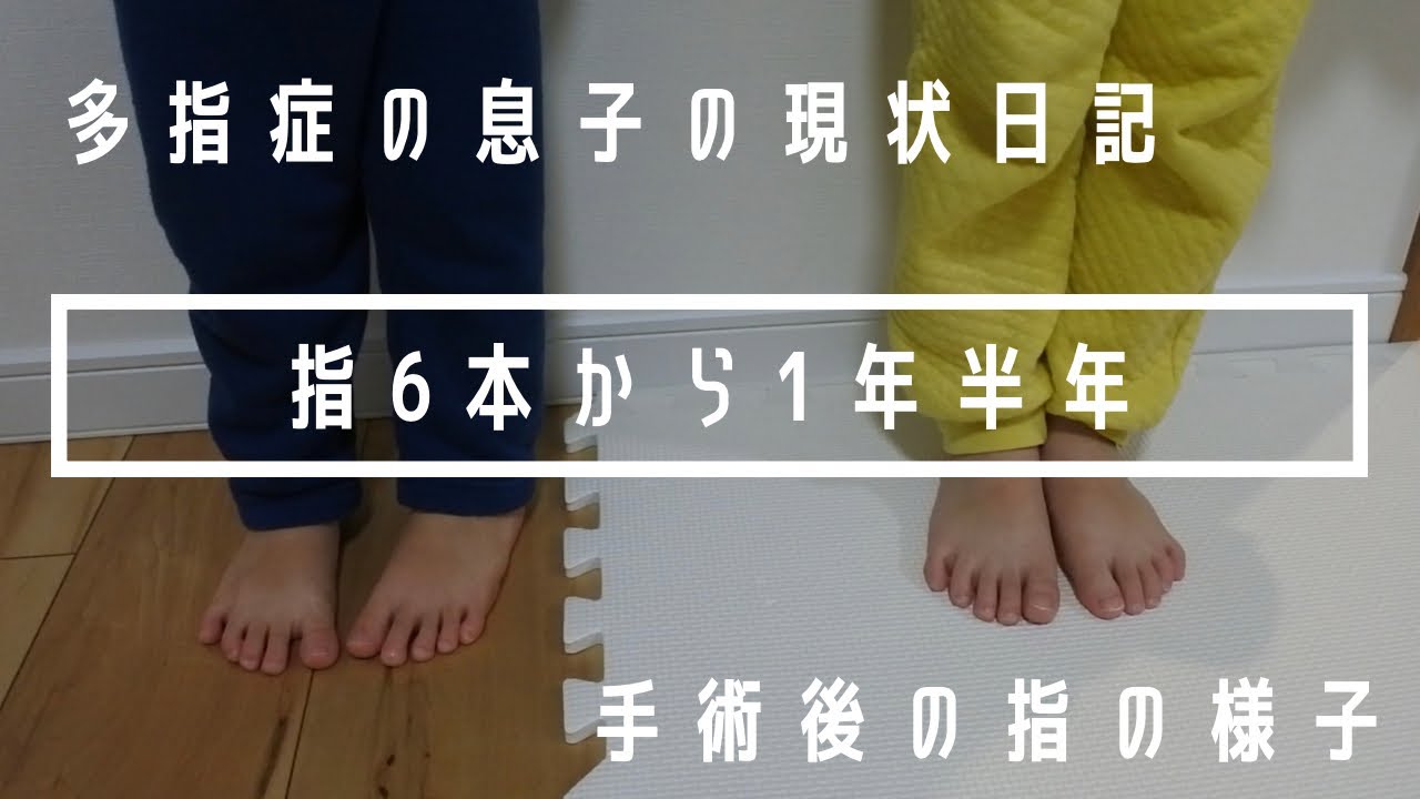 息子vlog👶多指症の息子.両足指6本.指の現状の様子 - YouTube