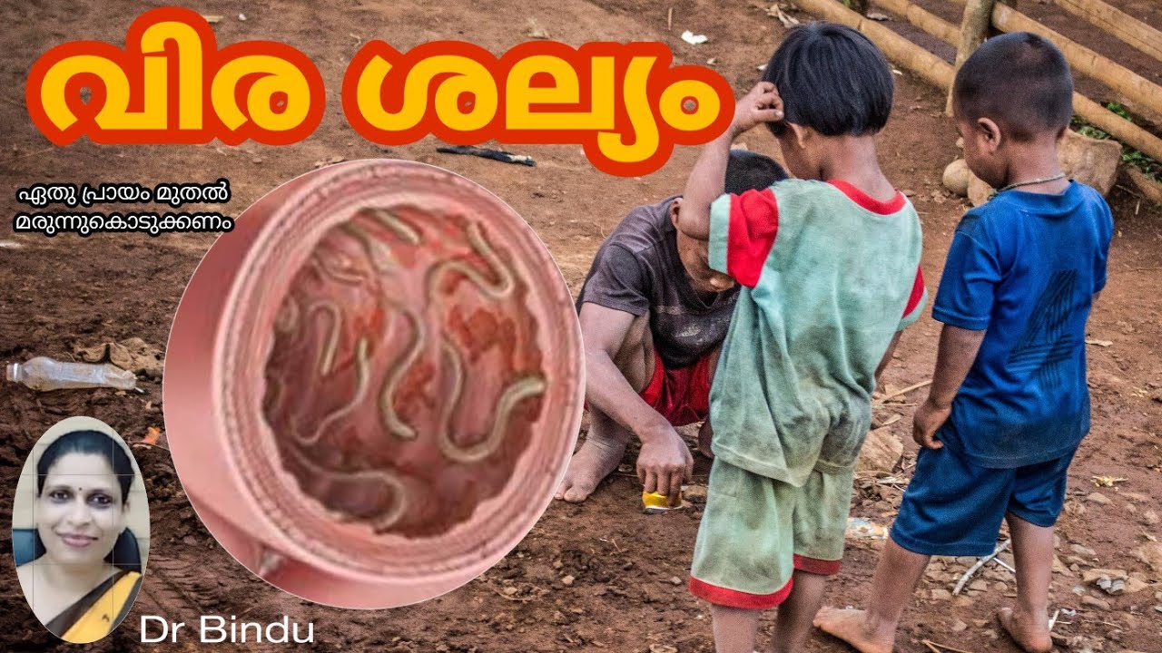 122 Worms in children/what to do/when to start treatment/malayalam
