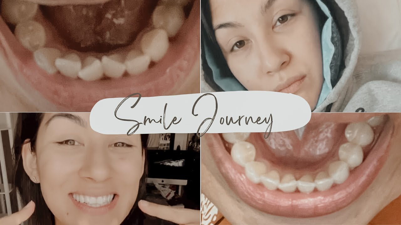 smile journey wisdom teeth removal & braces! YouTube