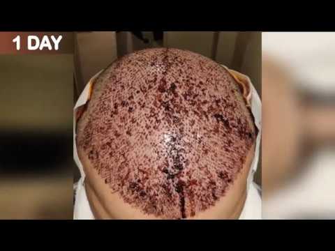 HAIR TRANSPLANT TIMELAPSE | DAY 1 TO DAY 153 | GROWTH IN 5 MONTHS |  BEFORE \u0026 AFTER