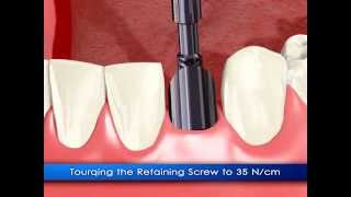 Реставрация одного зуба с помощью имплантата ADIN Touareg™ NP
