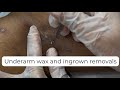 Underarm Wax Ingrown Hair Removal And Blackhead Removals Underarm Wax Ingrown Hair Removal And Blackhead Removals
