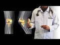 सांधेरोपण शास्त्रक्रिये नंतर ताके कडतना || Suture removal after total knee replacement ||